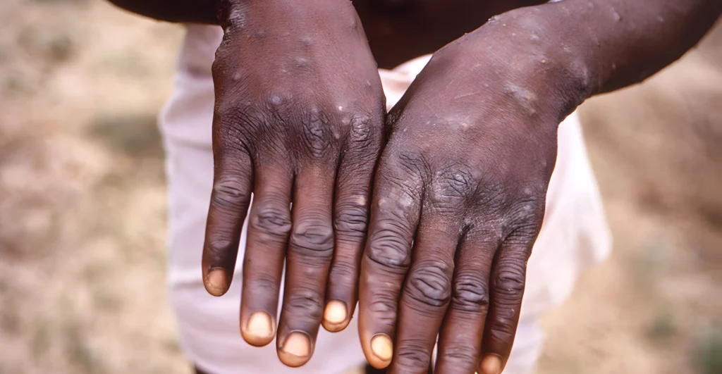 Africa CDC and WHO Call for $220 Million to Sustain Mpox Outbreak Control
